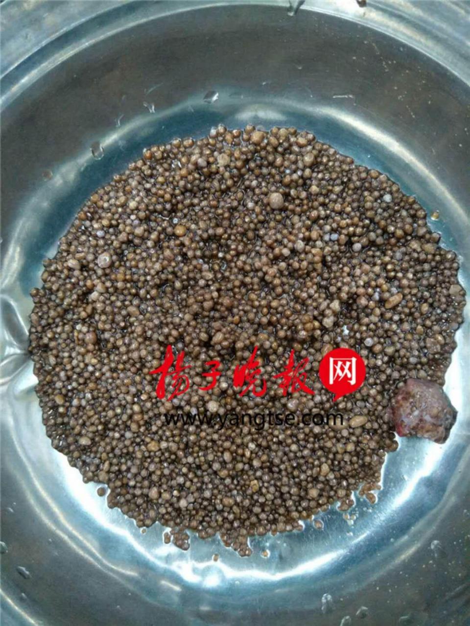 网传江苏一大妈肾脏长了2980颗结石？对肾结石你真的了解吗？