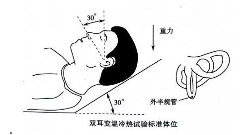 位置性眩晕眼震,眼震检查临床意义