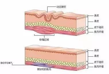有人劝你打玻尿酸,打玻尿酸的一些常识问题