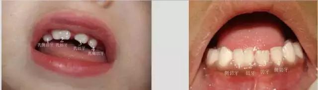 孩子两颗牙长在一起了怎么办,宝宝两颗牙长到一起怎么办