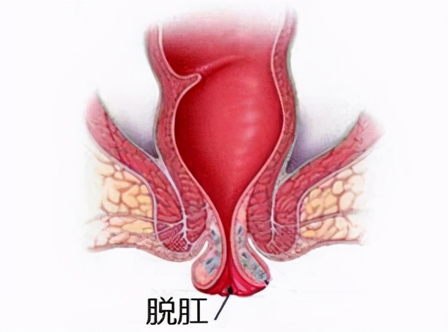 还在哺乳期的宝妈痔疮该如何处理,产后痔疮3个月了还没好怎么办