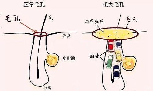 去黑头最有效最简单的方法,最简单有效的去黑头的方法