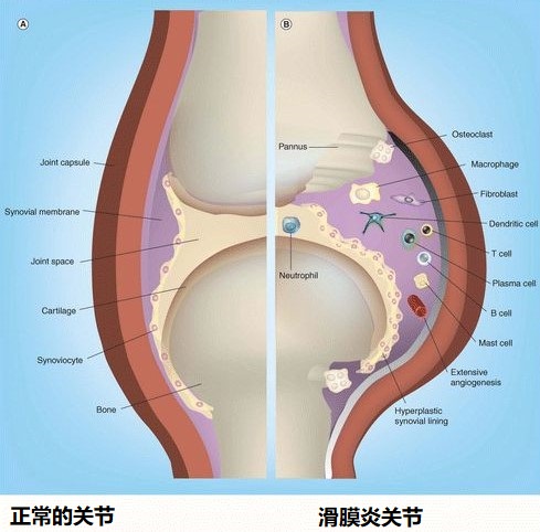 滑膜炎半年都看不好怎么回事,滑膜炎用什么膏药有效