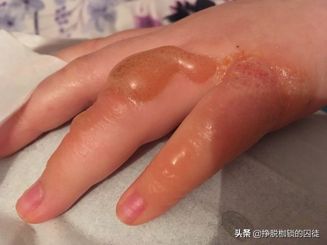 艾灸后出现水泡需求扎破吗,艾灸后起的水泡是排湿还是烫伤