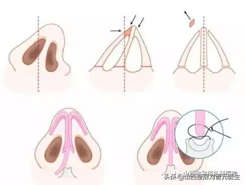 隆鼻的真实感受男生,男生隆鼻和女生的区分