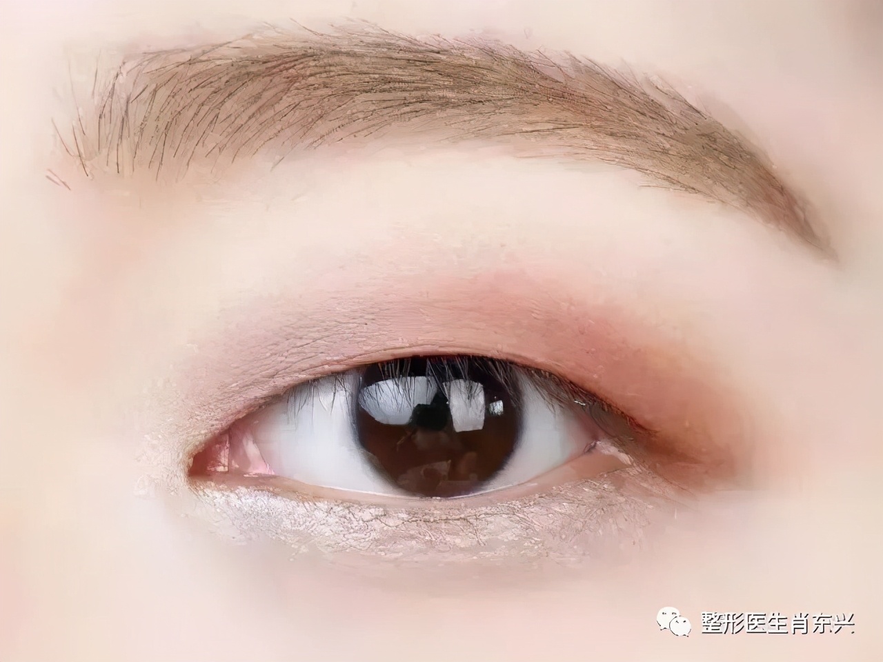 双眼皮埋线和割双眼皮有什么区分,除了割双眼皮怎么可以变成双眼皮