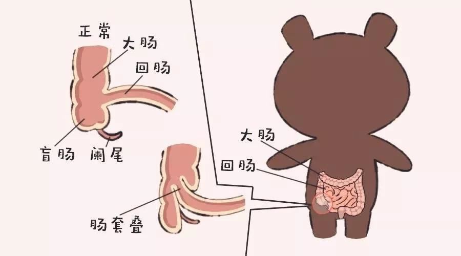 大肠的病难治还是小肠病难治,大肠套小肠是怎么回事