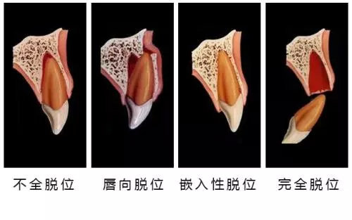 重度牙周炎是拔牙好还是治疗好,治疗牙周病需求拔除智齿吗