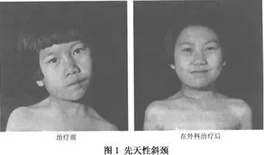 脸大小不对称怎么矫正,如何改善大小脸不对称