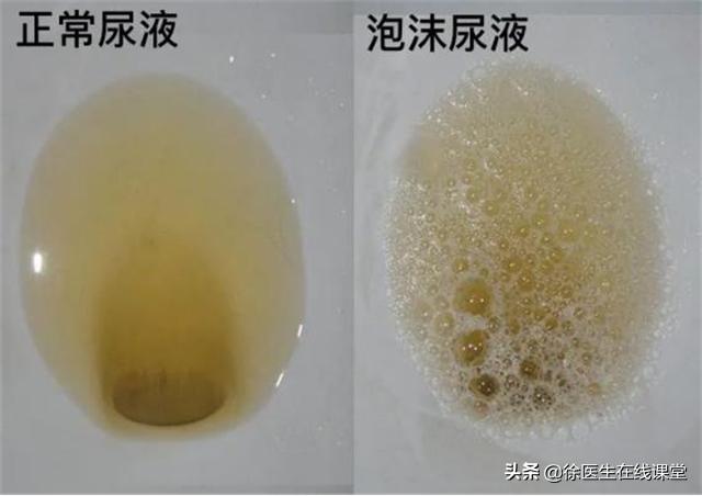 肾病综合征患者得肺癌怎么治疗,肾病综合征与肺癌患者