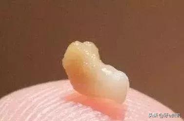 口腔三大疾病是哪几种,口腔里的结石有哪几种
