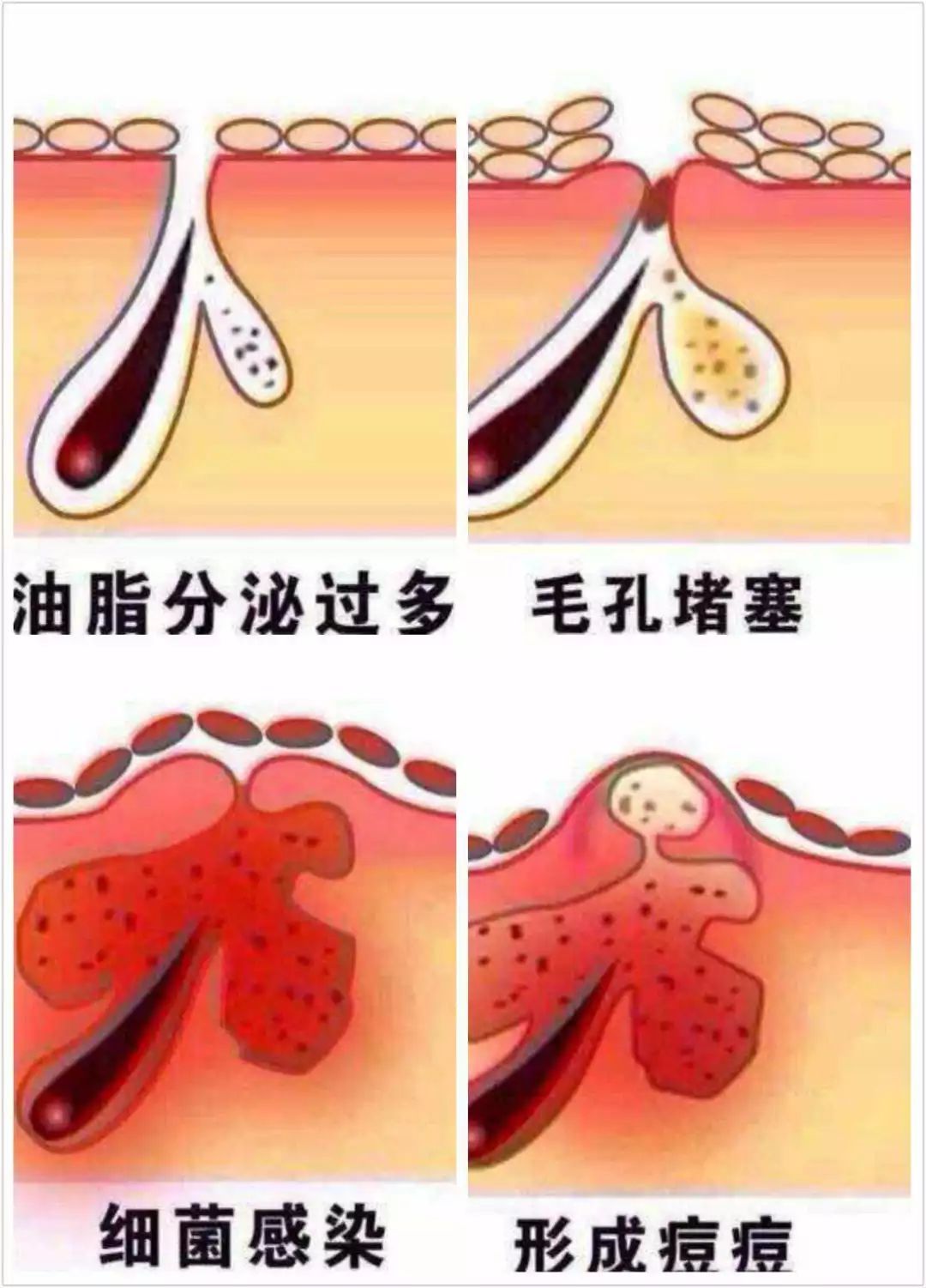 顽固性痘痘怎么治好得快,不知道从何而来的痘痘该如何治疗