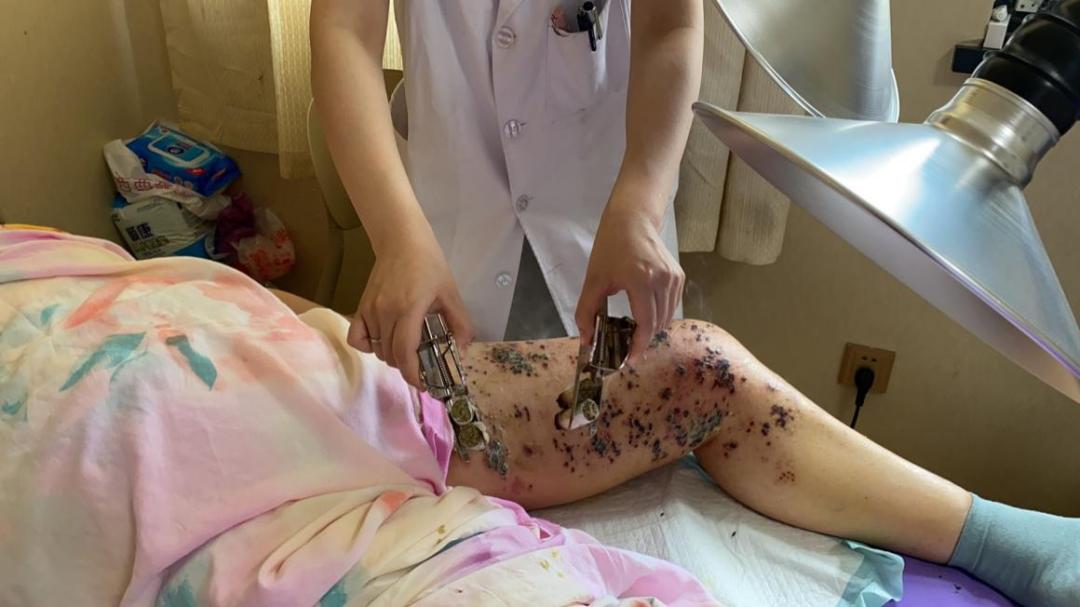 中药治疗带状疱疹后遗神经痛,中医带状疱疹红肿热痛