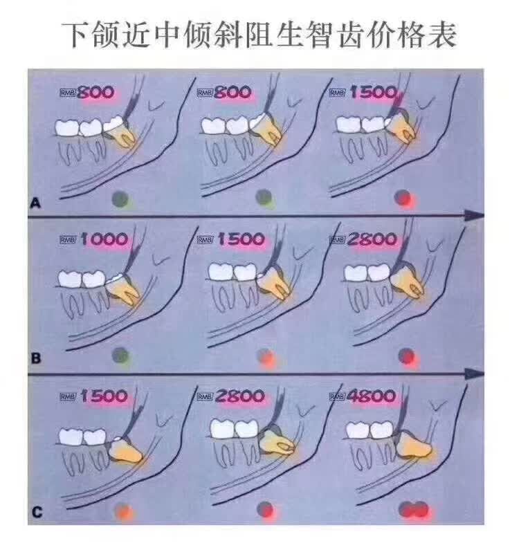 智齿拔除的价格和费用标准,拔正常智齿收费标准图
