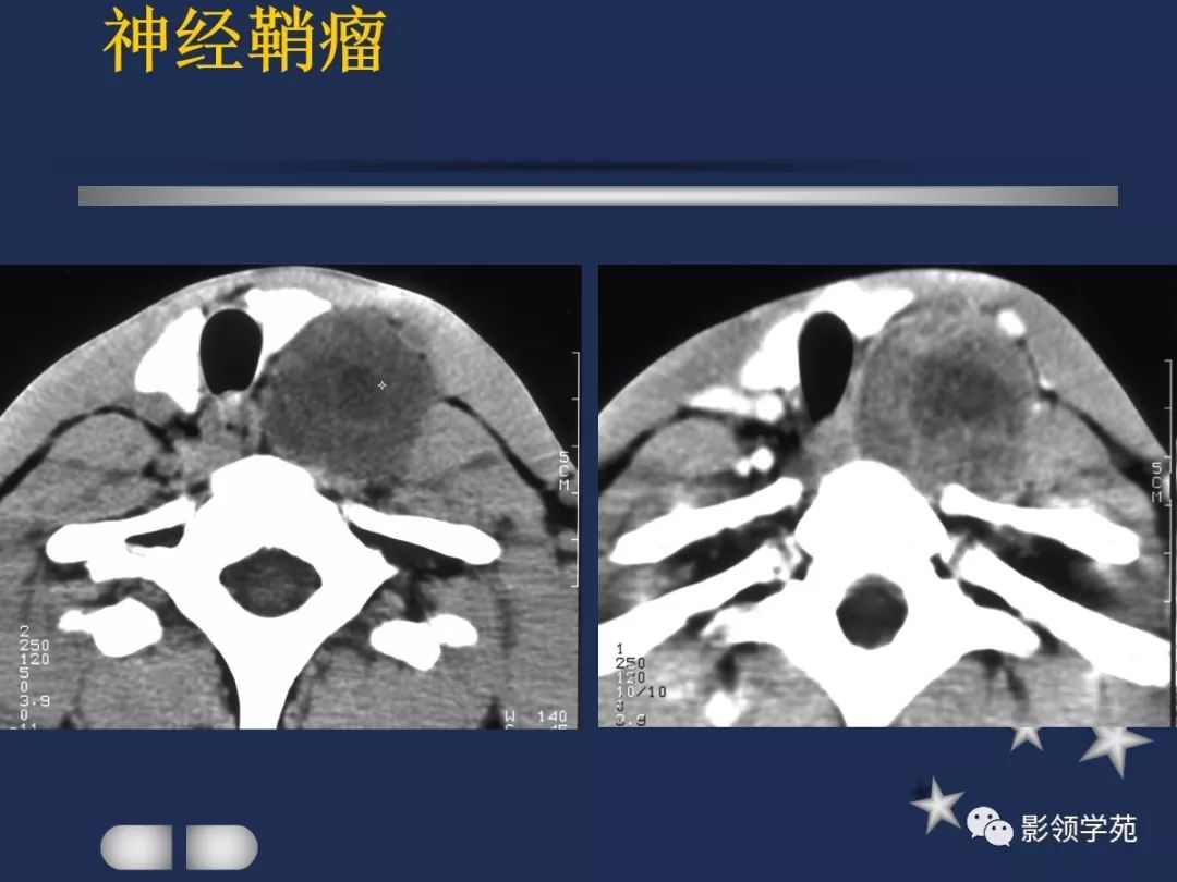腮腺疾病影像学诊断,腮腺肿块影像诊断