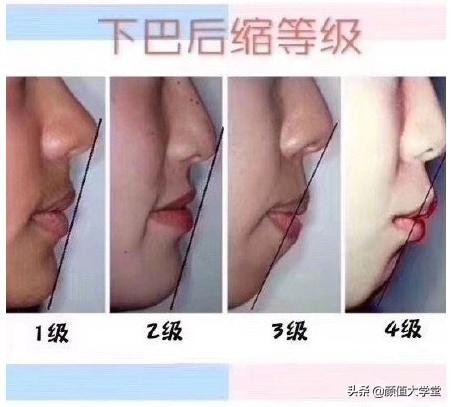 凸嘴有什么方法改善,形成嘴凸的原因