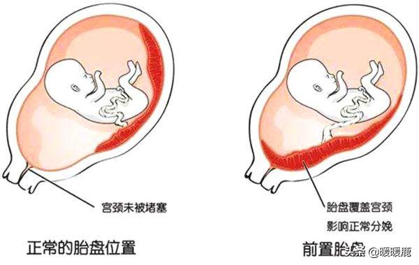 前壁胎盘和前置胎盘有什么区分,前壁胎盘和前置胎盘的区分有哪些