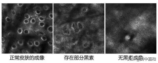 怎么区分黑痣与黑色素瘤,怎么区分黑色素瘤和痦子