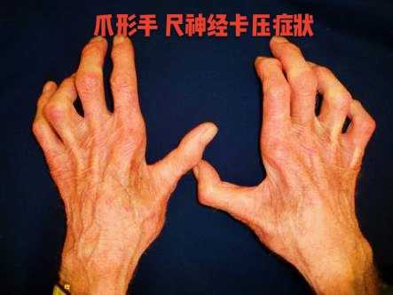 常见麻木病因和治疗方法,手部麻木的7种常见病因