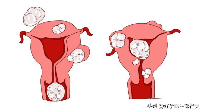 取环很难再怀上二胎吗,备孕二胎取环半年怀不上