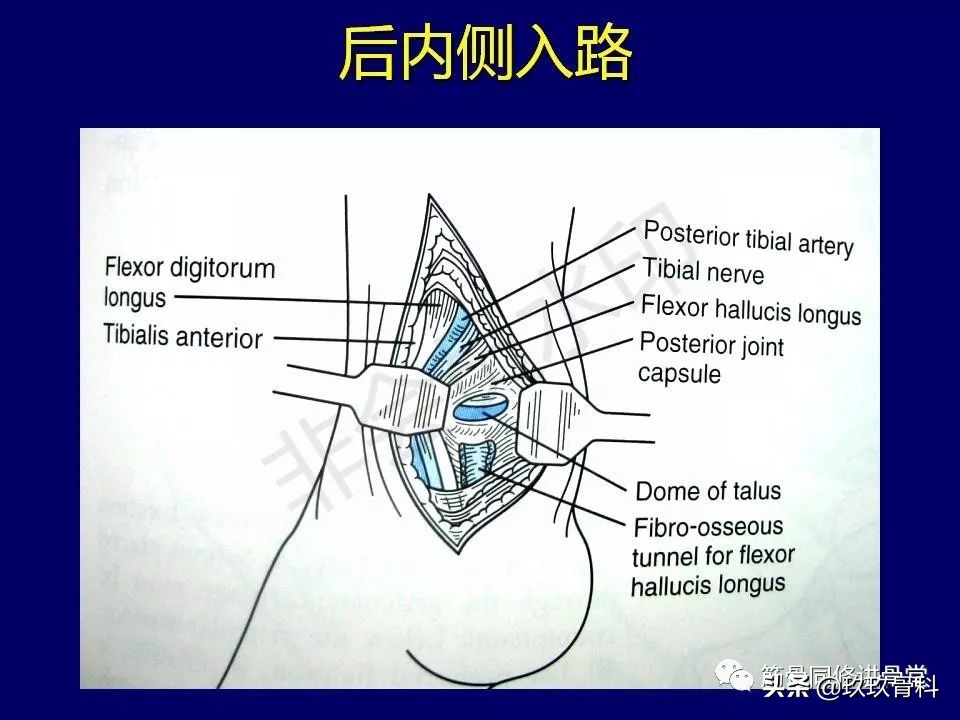 距骨骨折后遗症,距骨骨折怎么办