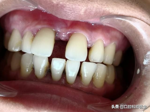 牙周炎引起门牙有缝,牙周炎导致门牙缝隙变大