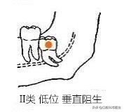 智齿分轻重嘛,智齿水平和非水平的区分