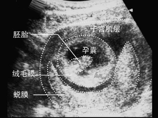 生化妊娠是几天形成的,生化妊娠完又怀孕孕周期怎么算