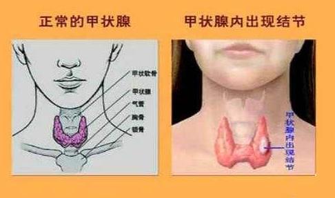 甲状腺结节ti-rads分级的判断标准,甲状腺ti-rads分类标准