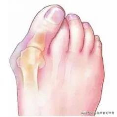 脚上长了东西好像是鸡眼但是不疼,脚上长鸡眼一样的疙瘩是什么