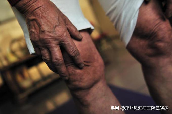 类风湿性关节炎怎么治疗才会变好,类风湿老不好怎么办