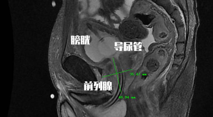 中医治疗前列腺增生什么药最有效,中医治疗前列腺增生多久能见效