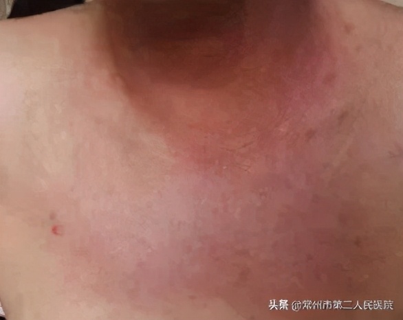得了皮肌炎，挂号是挂皮肤科？