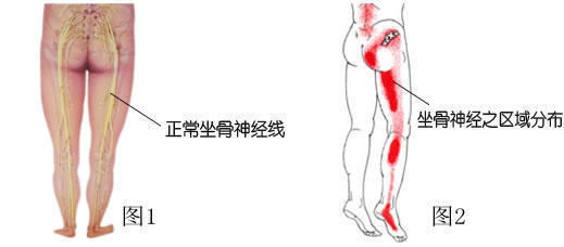 年轻人得了腰椎骨质增生怎么办,人们对骨质增生的常见误区