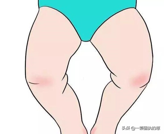 新生儿O型腿怎么办,40至50岁的o型腿能矫正过来吗