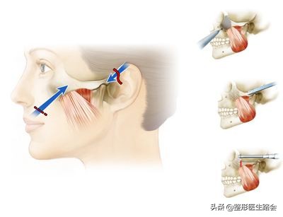 颧骨内推和颧弓有何区分,颧骨内推和颧突有什么区分