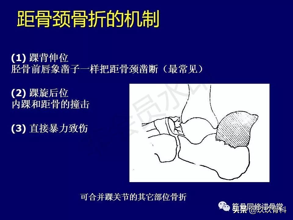 距骨骨折后遗症,距骨骨折怎么办