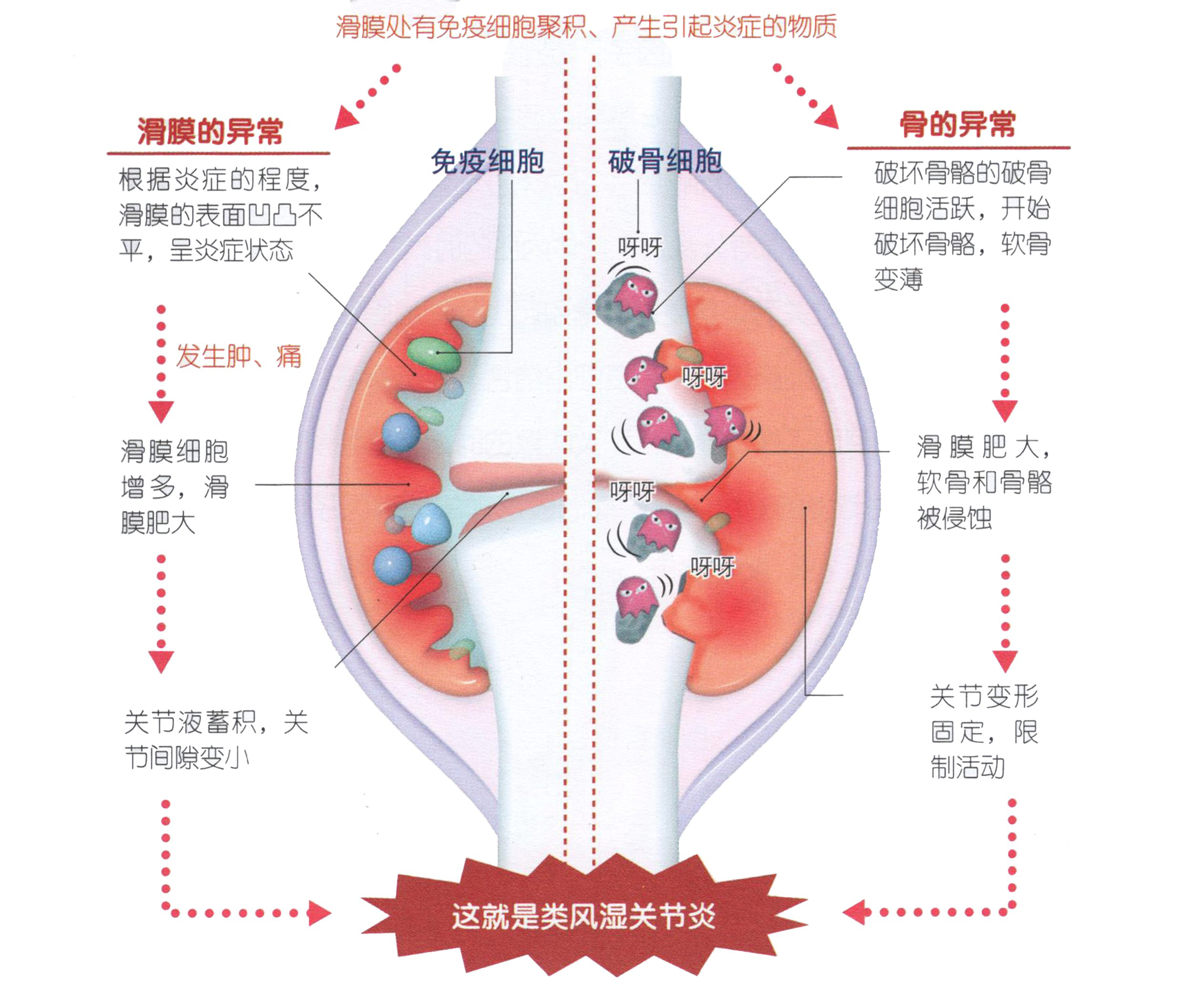 类风湿关节炎的炎症及关节破坏是如何发生发展的？如何正确消炎？