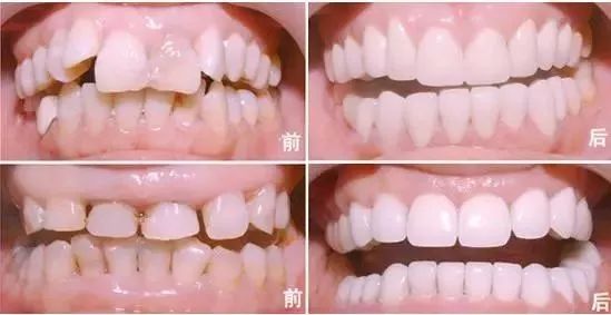 氧化锆全瓷牙的缺点和优点,牙医建议烤瓷不建议全瓷