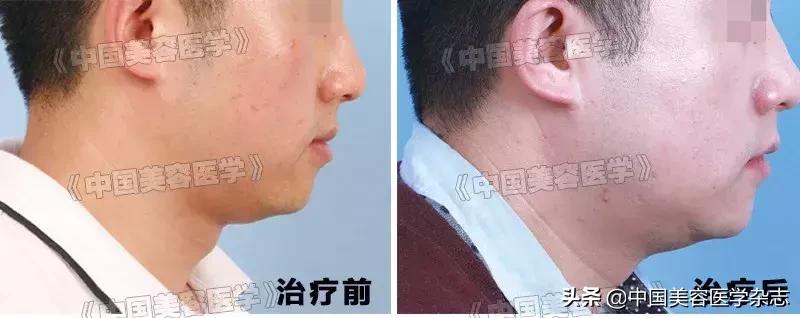 无托槽隐形矫治器矫正步骤,无托槽隐形矫治器牙齿松动