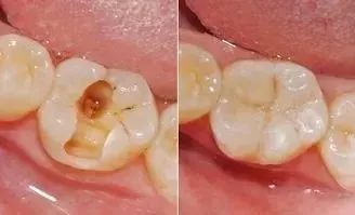 蛀牙总是一颗接着一颗？看来你不只是需求补牙了