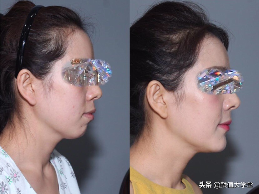 凸嘴有什么方法改善,形成嘴凸的原因