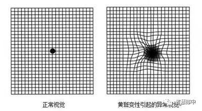 年龄相关性黄斑变性辅助检查,年龄相关性黄斑变性