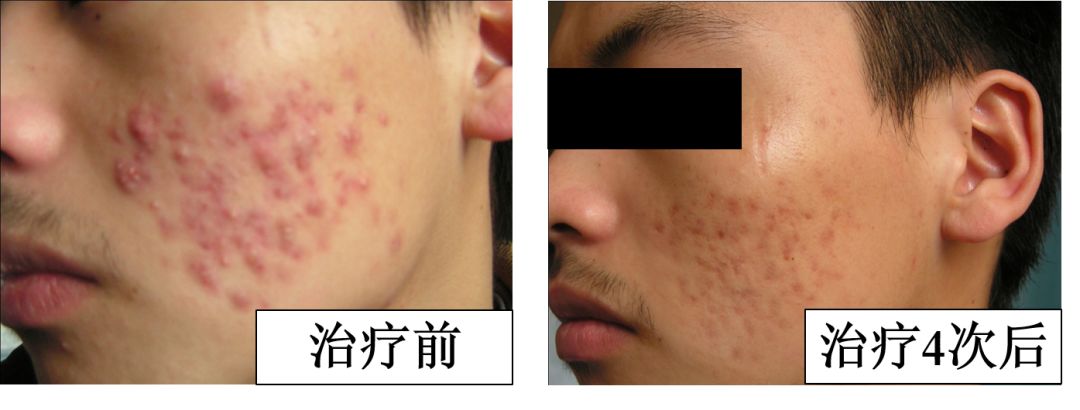 中医火针疗法教学视频,火针动手手法