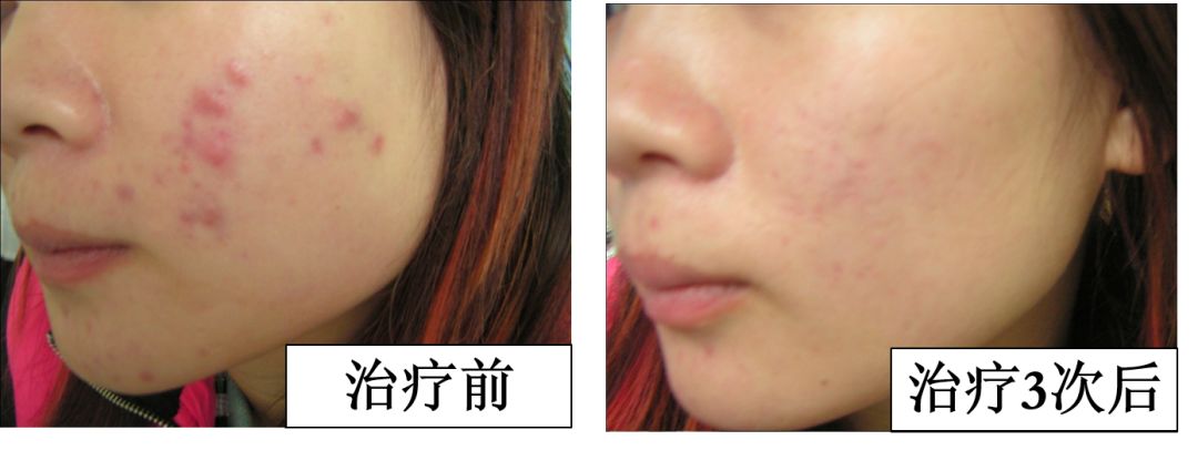 中医火针疗法教学视频,火针动手手法