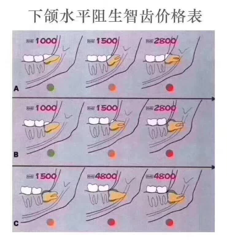智齿拔除的价格和费用标准,拔正常智齿收费标准图