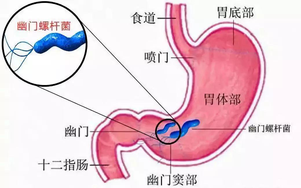 萎缩性胃炎与非萎缩性胃炎区分表,萎缩性胃炎和非萎缩胃炎哪个严重