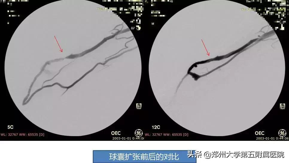 如何爱你，我的瘘？”系列科普之动静脉瘘失功后的处理