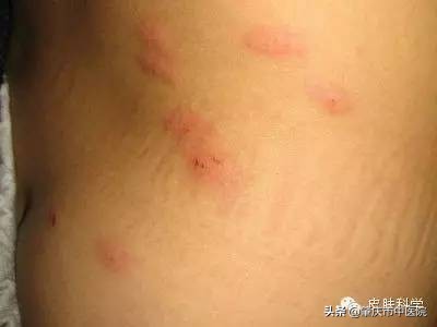 解读八种夏天易发皮肤病,冬季高发四类皮肤病该如何预防