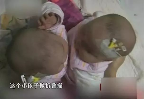 坐骨连体女婴现在状态,坐骨连体姐妹分离成功了吗